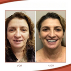 Silicone Denture Set Heat Moldable Custom Fit - Image 3