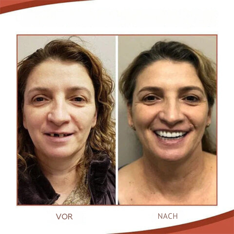 Silicone Denture Set Heat Moldable Custom Fit - Image 3