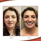 Snap On Veneers Custom Moldable Fit - Image 5